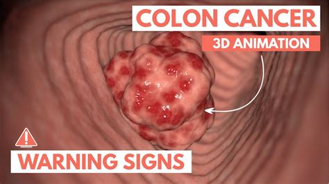 Unmasking Colon Cancer 5 Warning Signs You Shouldn T Ignore Schooltube