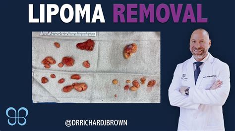 Lipoma Removal Surgery | Brown Plastic Surgery - YouTube