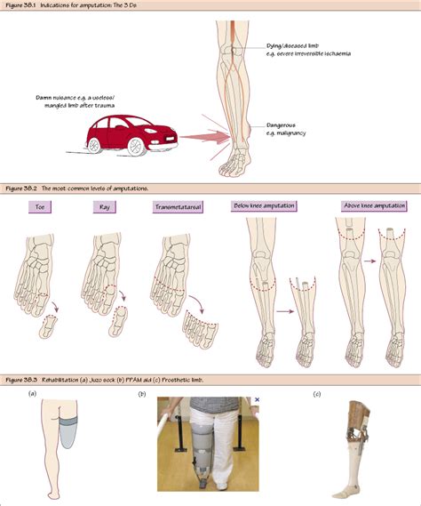 Amputation and Rehabilitation | Thoracic Key