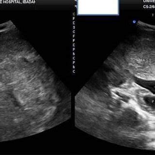 Transverse B Mode Ultrasound Showing The Left Renal Mass Crossing The