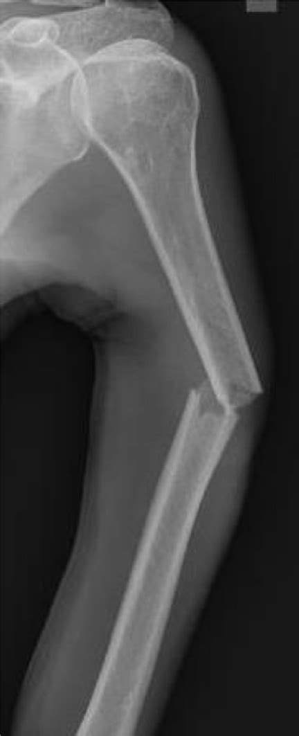 Fig A6 Fracture X Ray Image Of An Oblique Fracture Of The Left