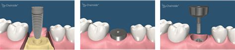 Dental Implant Procedures