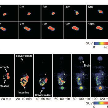 Representative Maximum Intensity Projection Mip Positron Emission