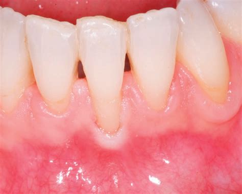 Table From Current Status And Perspectives Of Mucogingival Soft