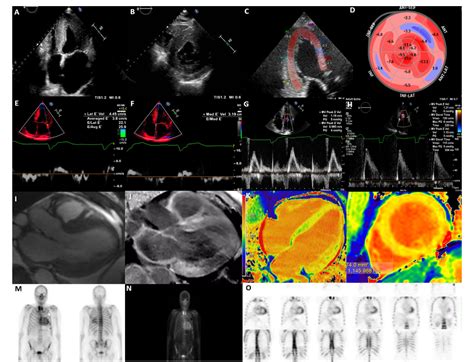 Figure 1 From The Role Of Multi Modality Imaging In The Diagnosis Of