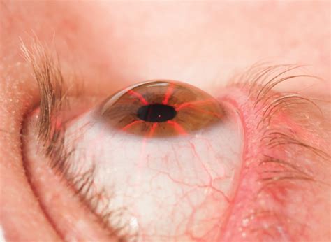 Corneal Crosslinking Reshaping Keratoconus Management