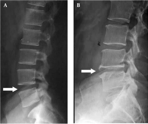 X-ray films of the lumbar spine from A, lateral view; and B, Lateral ...