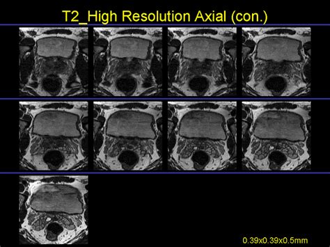 9 The High Resolution T2 Weighted Mr Images By T2 Weighted 3d Tsedrive