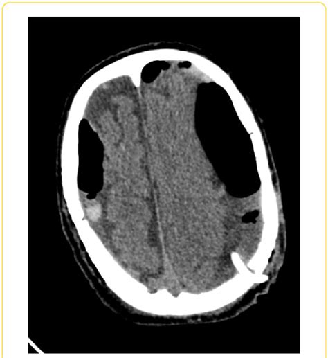 Initial CT-scan showing tension pneumocephalus. | Download Scientific Diagram