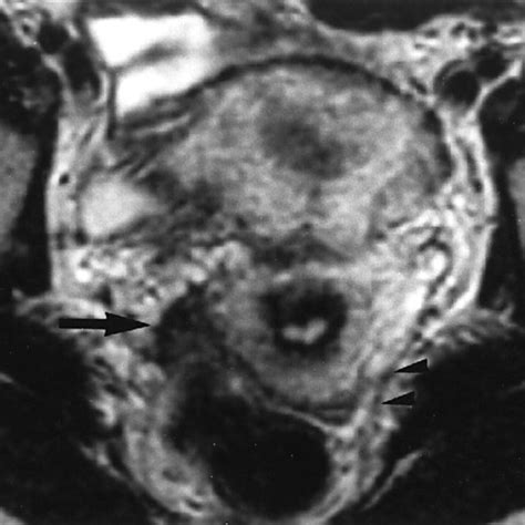 Deep Endometriosis Of The Right Uterosacral Ligament Usl Extending To