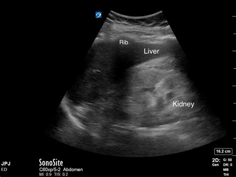 Hyperechoic Ultrasound