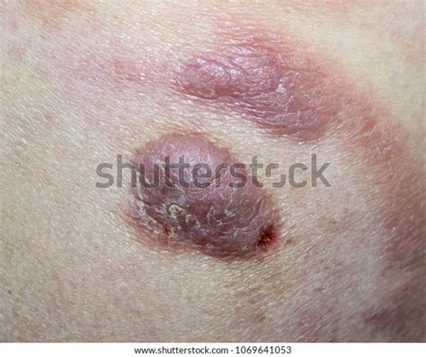 Mycosis Fungoides Cutaneous Tcell Lymphoma Stock Photo Edit Now