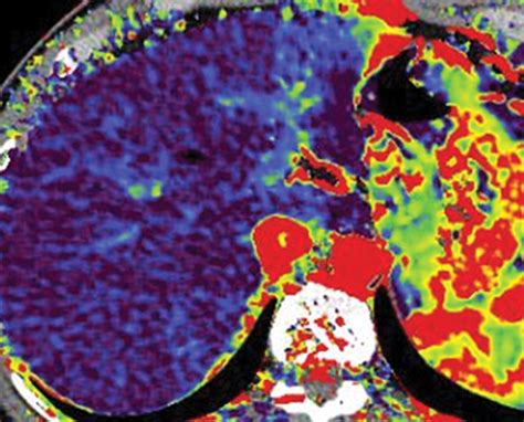 Quantitative Color Mapping Of The Arterial Enhancement Fraction In