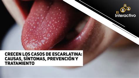 Crecen los casos de escarlatina causas síntomas prevención y