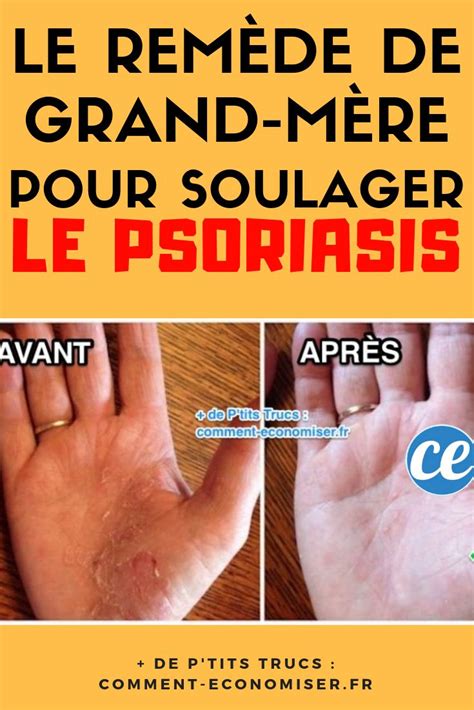 Le Rem De De Grand M Re Efficace Pour Soulager Le Psoriasis Rapidement