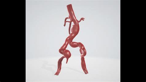 ⚕️ Case 1 to 6: 3D aortic and iliac artery aneurysm・ STL File for 3D ...