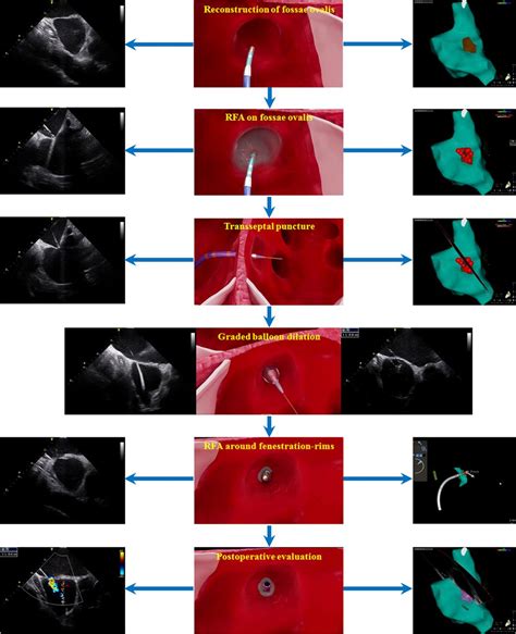 First In Human Modified Atrial Septostomy Combining Radiofrequency