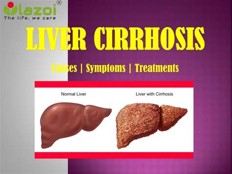 PPT Cirrhosis Of The Liver A Critical Health Condition PowerPoint