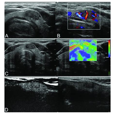 Ultrasound Us Characteristics Of Benign And Malignant Thyroid Nodules Download Scientific