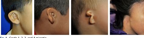 Figure 1 From Pediatric Microtia Reconstruction With Autologous Rib