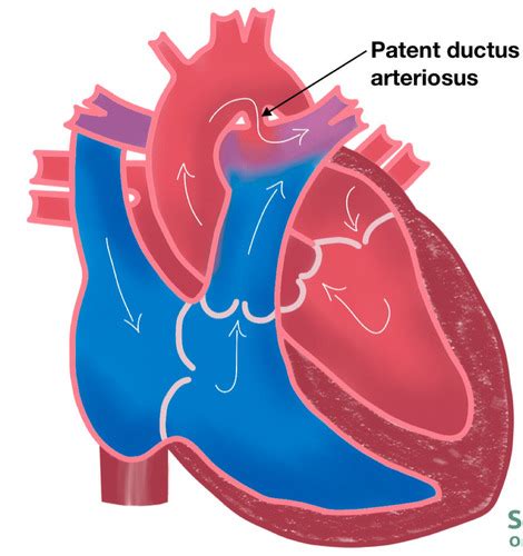 Cvs Lec Congenital Heart Defects Flashcards Quizlet