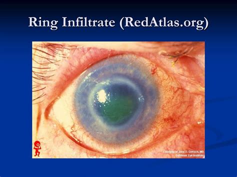 Ppt Infectious Keratitis Differential Diagnosis And Clinical Considerations Powerpoint