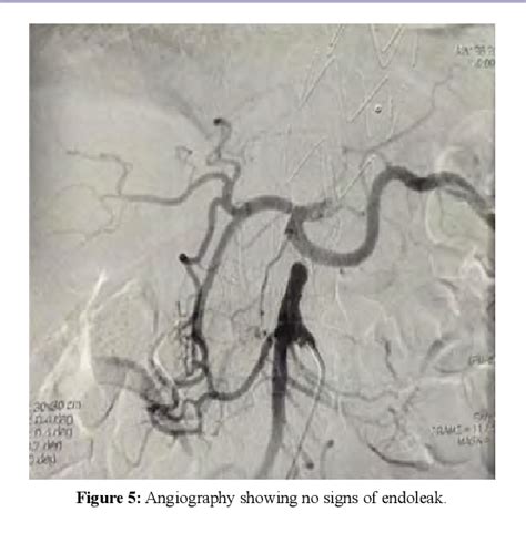 Figure From Two Stage Hybrid Open And Endovascular With Uncovered