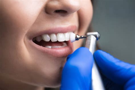 Limpeza nos dentes como é feita e quando fazer