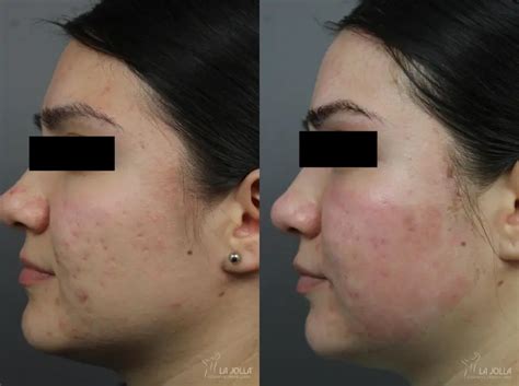 Acne Scars Before After Gallery Patient 1