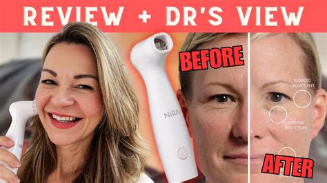 NIRA PRO Laser Review W Before And Afters Would I Use It Long Term