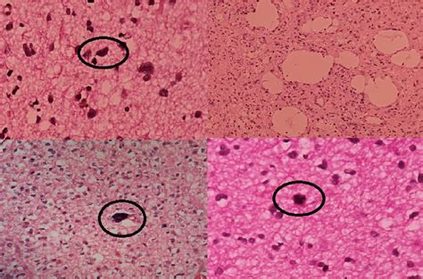 Glioma Versus Gliosis The Presence Of Enlarged Hyperchromatic Nuclei