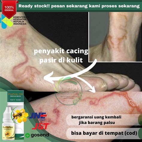 Jual Obat Cacaing Pasir Obat Cacing Pasir Di Kulit Obat Cacing