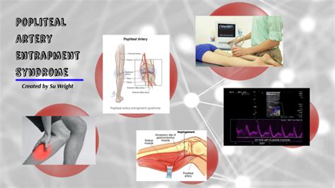 Popliteal Artery Entrapment Syndrome by Su Lu on Prezi