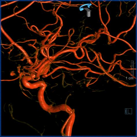 Anterior Choroidal Artery | neuroangio.org