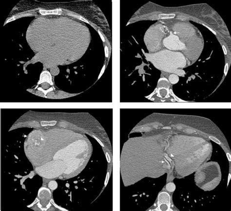 CT Scan Images Without Contrast A And With Contrast BD A At