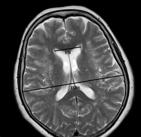 Axial T Weighted Turbo Spin Echo Mri Tr Te Ms Of A