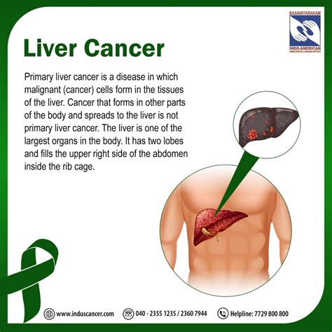 Understanding Liver Cancer Causes Symptoms Prevention And Treatment Induscancer