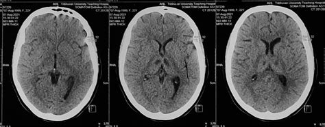 Noncontrast Ct Scan Of Head Showing Bilateral Thalamic Hypodensity