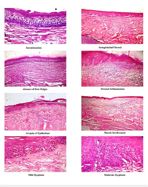 Histopathological Features Of Different Grades Of Osmf In Hematoxylin