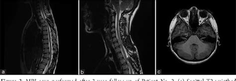 Figure From Spinal Meningiomas In Pediatric Patients A Case Series