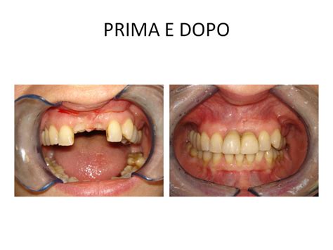 Problema A Entrambi Incisivi Superiori Dentista Roma