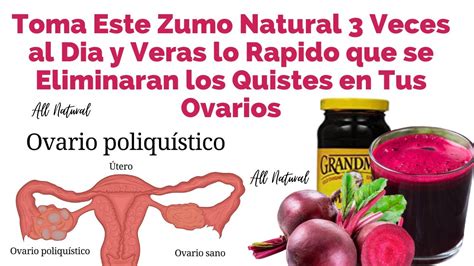 Remedio Natural para Eliminar los Ovarios Poliquísticos YouTube