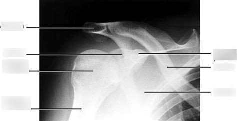 Med Imaging MSK XRAY Right Shoulder AP Diagram Quizlet