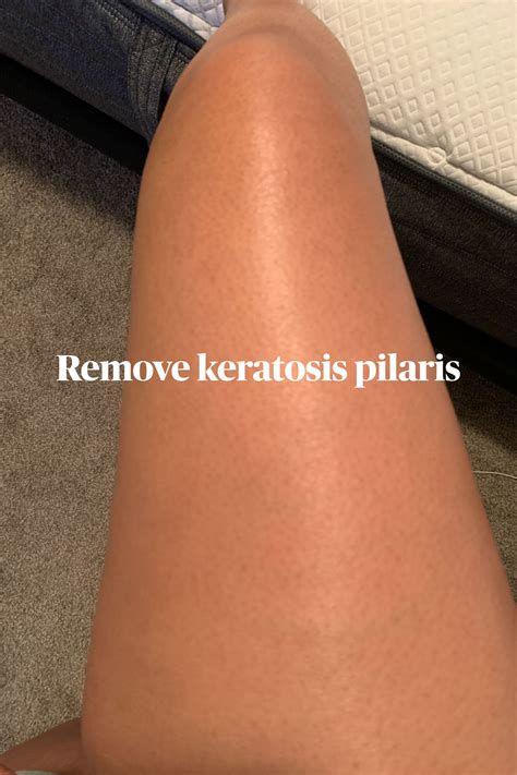 How To Heal Keratosis Pilaris With Diet Artofit