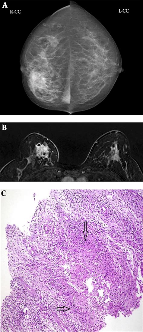 A Year Old Woman With Non Fistular Idiopathic Granulomatous Mastitis