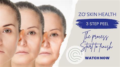 Zo Skin Health 3 Step Peel Youtube