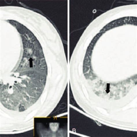 A B Chest Computed Tomography Scan On Admission Revealed Bilateral