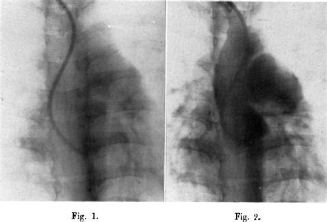 Figure 1 From Visualization Of Patent Ductus Arteriosus Botalli By