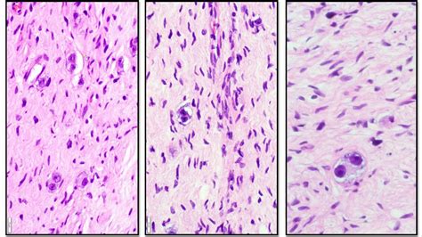 Neuroblastoma And Ganglioneuroma Adventures In Neuropathology Youtube