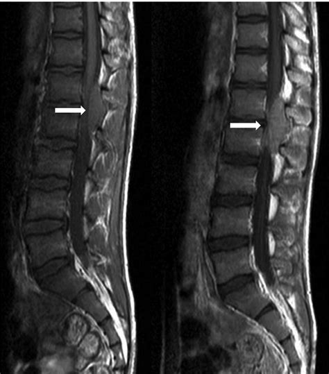 Lumbosacral Magnetic Resonance Imaging Mri Without And With